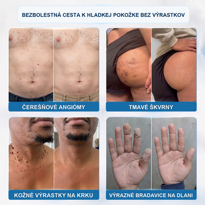Hivatalos Márkabolt | ✌️ Creawel®  7 napos Szemölcseltávolító Roll-on Ápoló Folyadék (Fájdalommentes rollerball technológia, hegek nélkül)