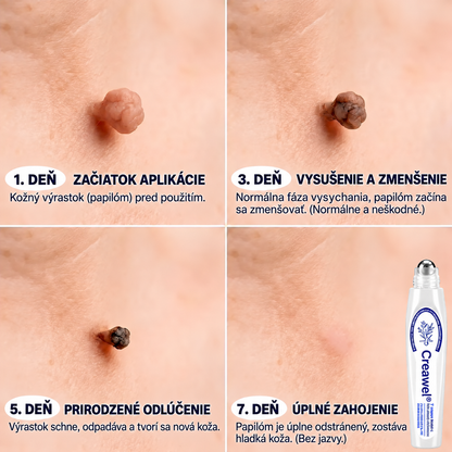 Hivatalos Márkabolt | ✌️ Creawel®  7 napos Szemölcseltávolító Roll-on Ápoló Folyadék (Fájdalommentes rollerball technológia, hegek nélkül)