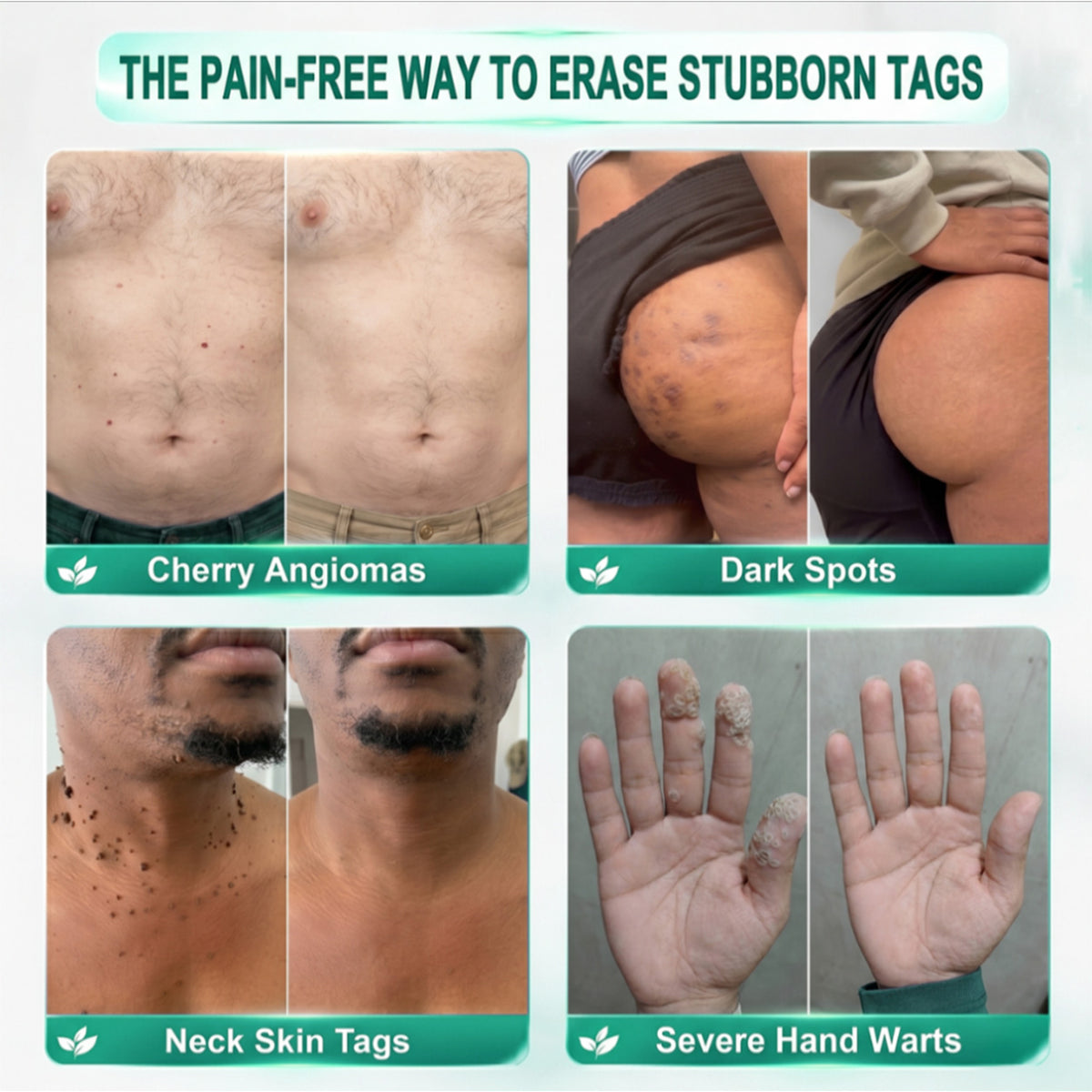 🌟 𝐎𝐟𝐟𝐢𝐜𝐢𝐚𝐥 𝐒𝐭𝐨𝐫𝐞 | GFOUK®  🍃𝐁𝐨𝐭𝐚𝐧𝐢𝐜𝐚𝐥 𝐌𝐢𝐜𝐫𝐨𝐧𝐞𝐞𝐝𝐥𝐞 𝐇𝐲𝐝𝐫𝐨𝐜𝐨𝐥𝐥𝐨𝐢𝐝 𝐏𝐚𝐭𝐜𝐡 (𝐅𝐨𝐫 𝐒𝐤𝐢𝐧 𝐓𝐚𝐠𝐬, 𝐒𝐦𝐚𝐥𝐥 𝐒𝐤𝐢𝐧 𝐆𝐫𝐨𝐰𝐭𝐡𝐬, 𝐖𝐚𝐫𝐭𝐬, 𝐌𝐨𝐥𝐞𝐬, 𝐀𝐠𝐞 𝐒𝐩𝐨𝐭𝐬 & 𝐏𝐢𝐠𝐦𝐞𝐧𝐭𝐚𝐭𝐢𝐨𝐧 𝐂𝐨𝐧𝐜𝐞𝐫𝐧𝐬)