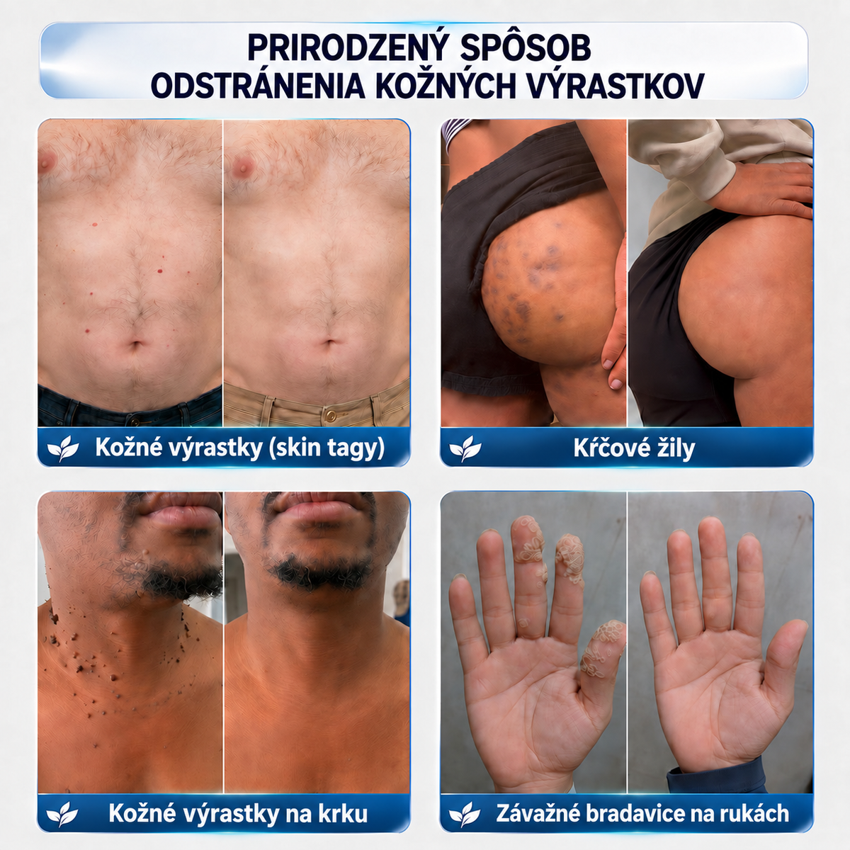 ♟️ CureVivo® 7-dňový krém na kožné výrastky a škvrny (bezbolestné zloženie – bez jaziev)🤗