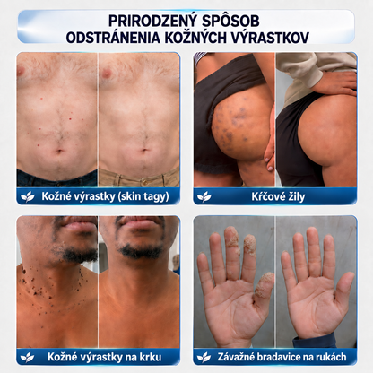 ♟️ CureVivo® 7-dňový krém na kožné výrastky a škvrny (bezbolestné zloženie – bez jaziev)🤗